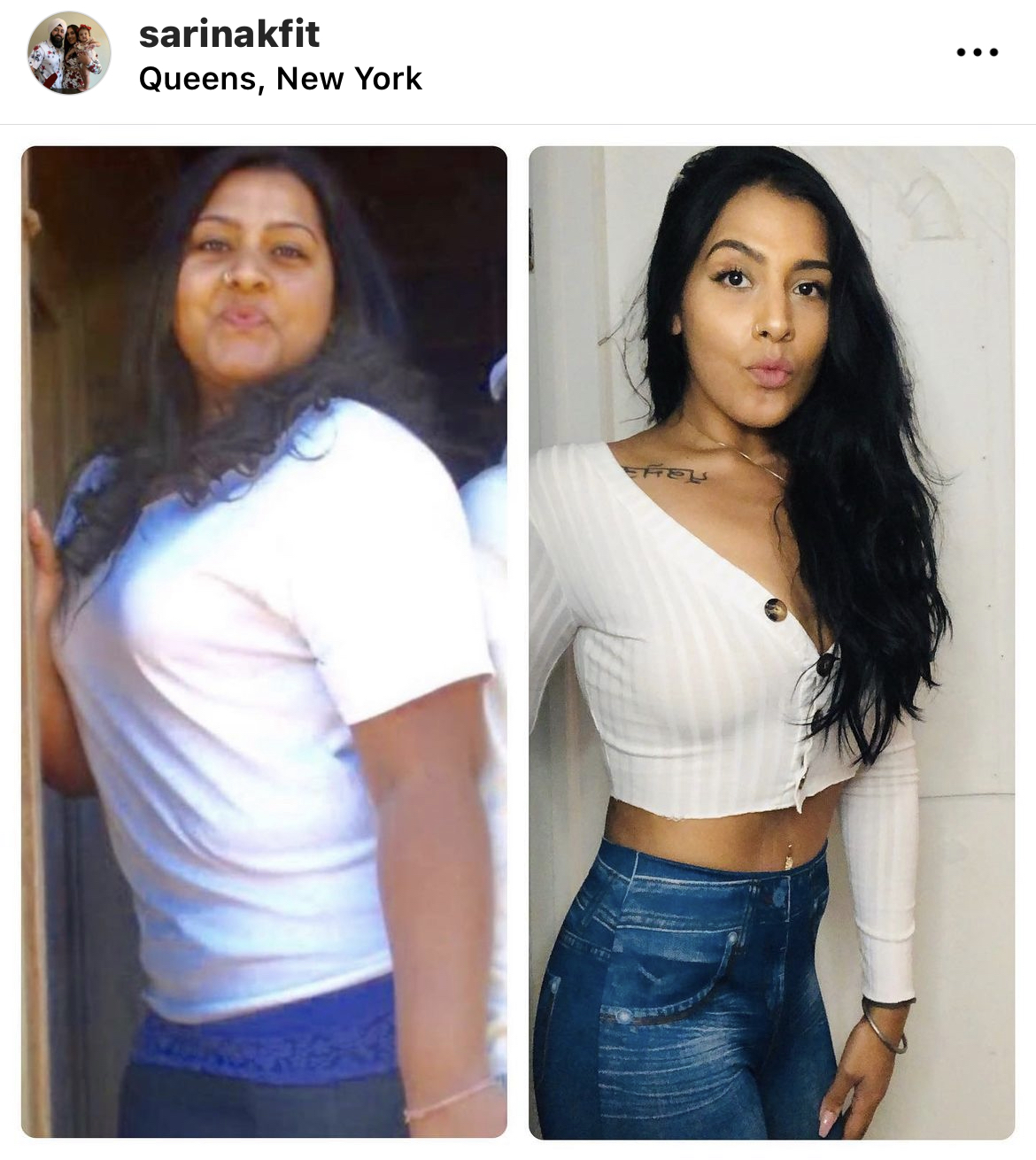 AFTER WEIGHT LOSS SURGERY COLOMBIA